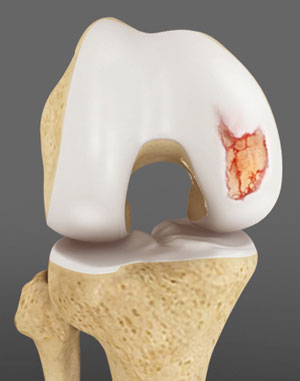 Chondral (Articular Cartilage Defects)