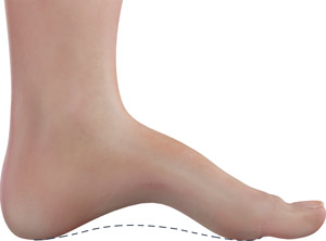 Cavovarus Foot Correction