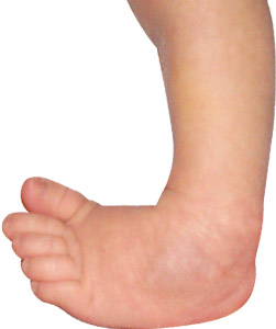 Club foot and Congenital Deformity