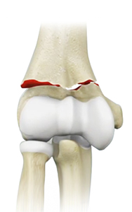 Elbow Fractures