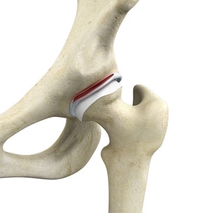 Hip Fracture