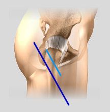 Minimally Invasive Total Hip Replacement