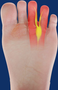 Morton's Neuroma