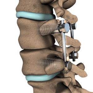 Spinal Fusion