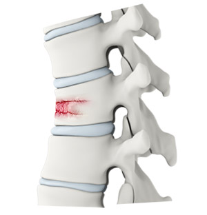 Fractured Sternum Compensation Tujunga thumbnail