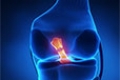 Why an Untreated ACL Tear May Cause Future Injuries