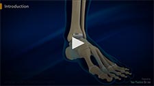 Ankle Joint Replacement