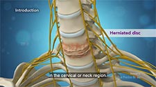 Anterior Cervical Discectomy with Fusion