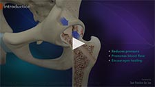 Core Decompression for Avascular Necrosis of the Hip