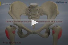 Hip Bursitis