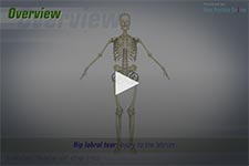 Hip Labral Tear