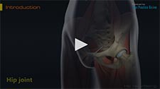Hip Resurfacing