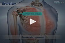 Minimally Invasive Shoulder Joint Replacement