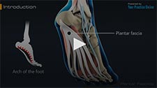 Plantar Fasciitis