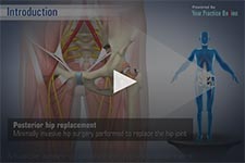 Posterior Hip Replacement