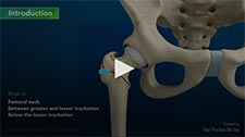 Subtrochanteric Hip Fracture