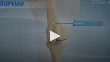 Total Knee Replacement